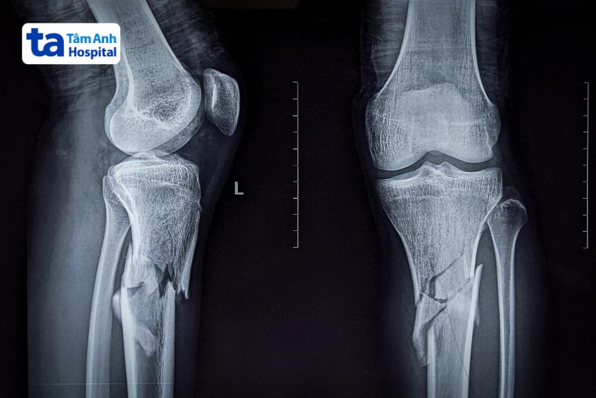 Loãng xương do viêm khớp gối