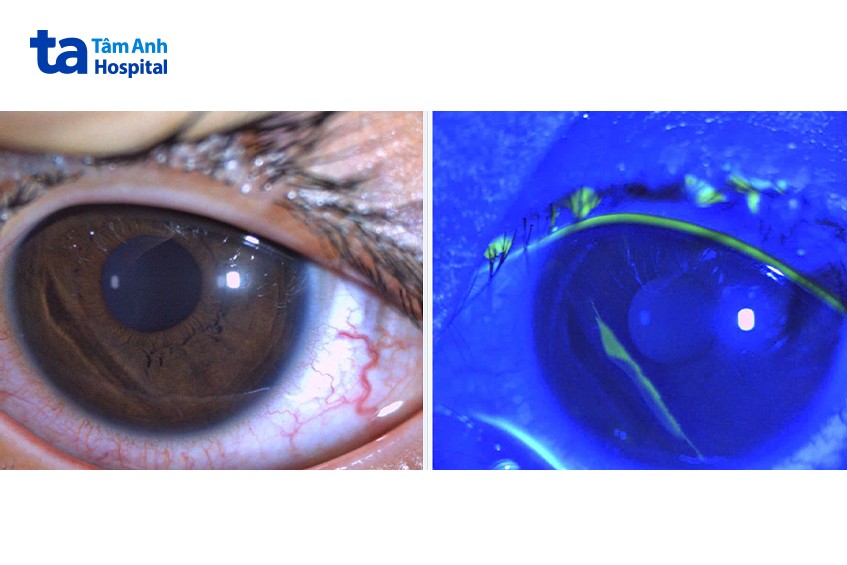 mắt bệnh nhi 4 tuổi