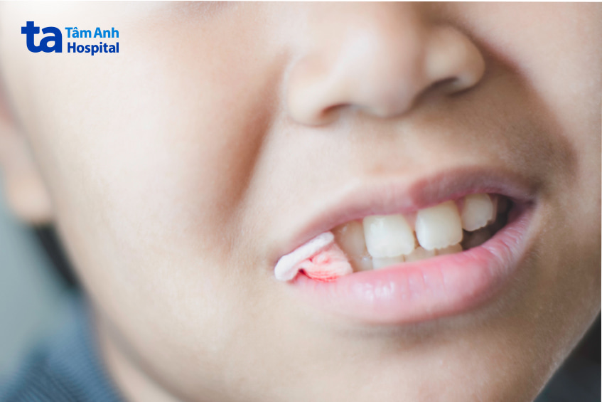 mẹo cầm máu sau khi nhổ răng