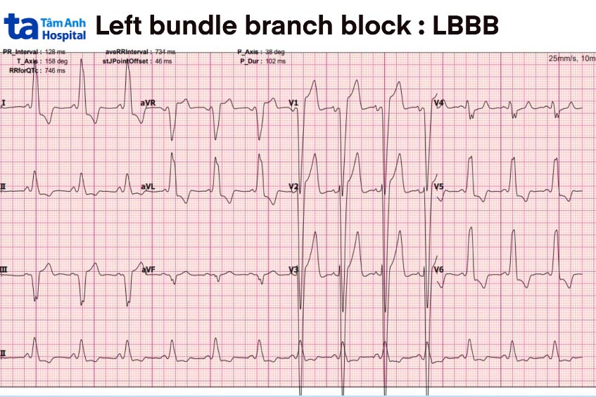 Minh họa tiêu chuẩn chẩn đoán block nhánh trái trên ECG