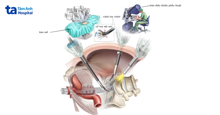 mô hình phẫu thuật nội soi bằng robot đặt lưới âm đạo