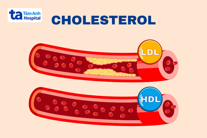 Mỡ máu cao là tình trạng gia tăng LDL cholesterol trong máu