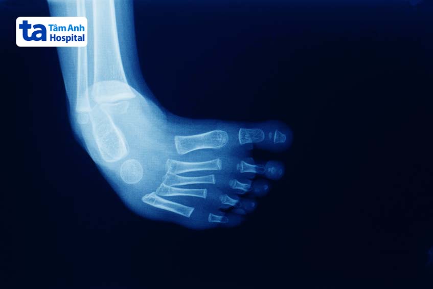 Điều trị chân khoèo ở trẻ từ sớm để ngăn biến chứng lâu dài