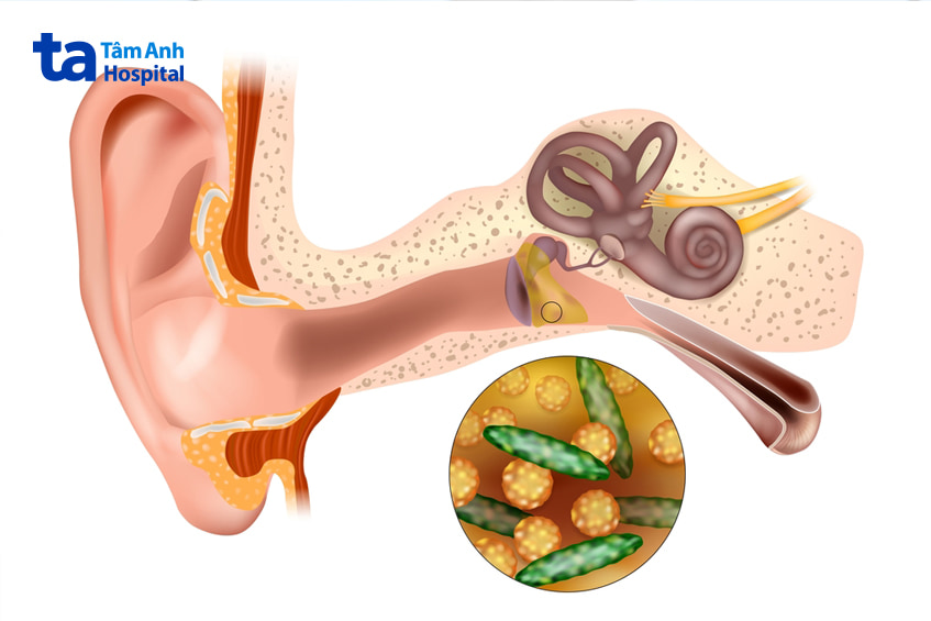 Các yếu tố nguy cơ và nguyên nhân gây lãng tai là gì?