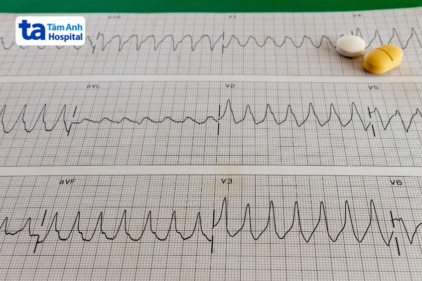 Nhịp nhanh QRS rộng đặc trưng bởi tần số thất nhanh trên 100 lần/phút và phức bộ QRS > 120ms