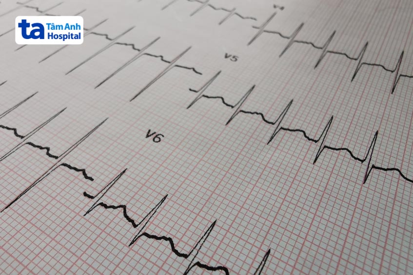 Nhịp nhanh trên thất là tình trạng rối loạn nhịp tim thường gặp, nhịp nhanh bất thường