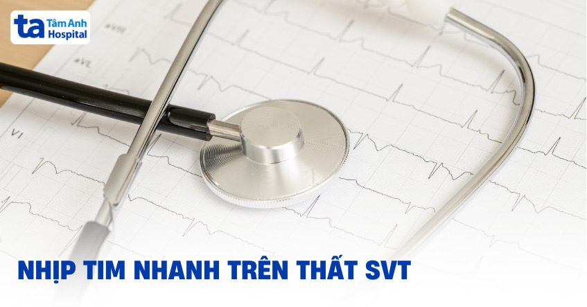 Nhịp nhanh trên thất: Nguyên nhân, triệu chứng, chẩn đoán, điều trị