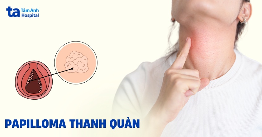 Papilloma thanh quản: Nguyên nhân, triệu chứng và phòng ngừa