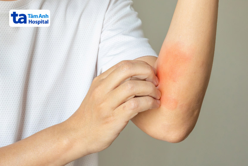 Phát ban, mẩn ngứa là một trong những tác dụng thường gặp khi điều trị bằng Anthracycline