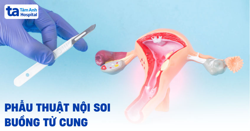 Phẫu thuật nội soi buồng tử cung là gì? Chỉ định thực hiện mổ