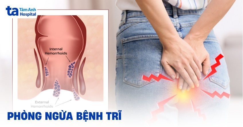 6 cách phòng ngừa bệnh trĩ hiệu quả, hướng dẫn chi tiết
