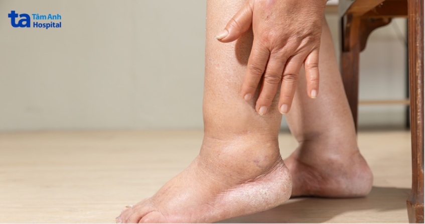 phù nề do quá tải chất lỏng là triệu chứng dễ nhận biết