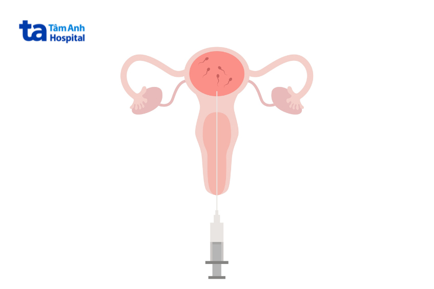 Phụ nữ càng lớn tuổi, khả năng IUI thành công càng giảm