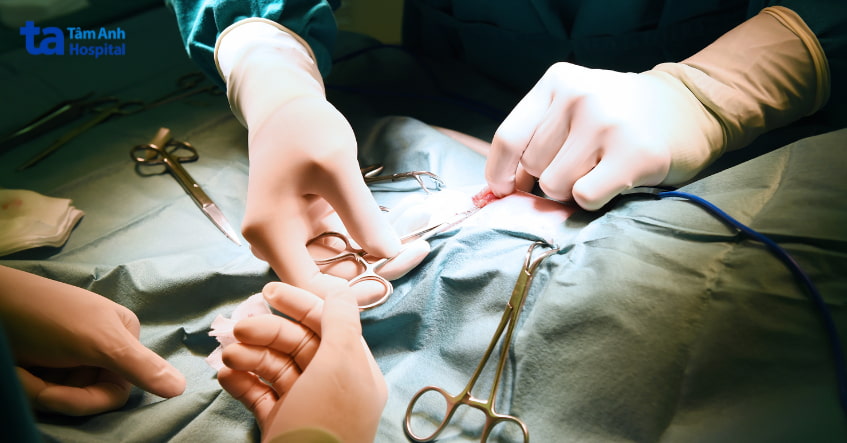 phương pháp điều trị ung thư đại tràng bằng phẫu thuật