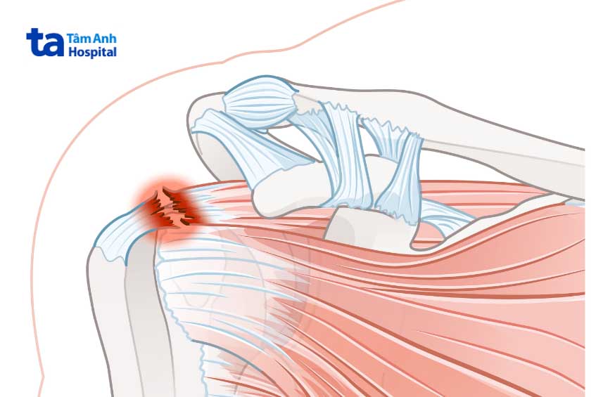 Rách đứt gân cơ trên gai