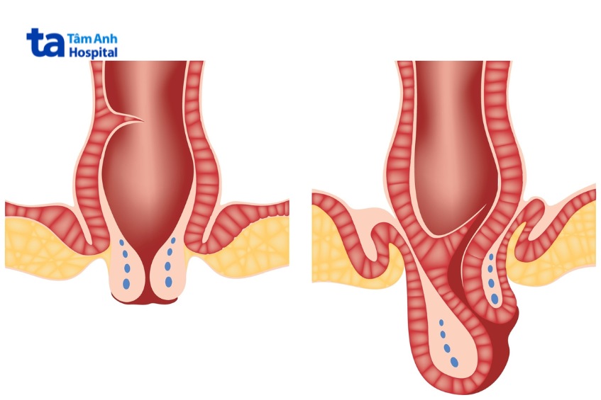 sa búi trĩ bị đau không