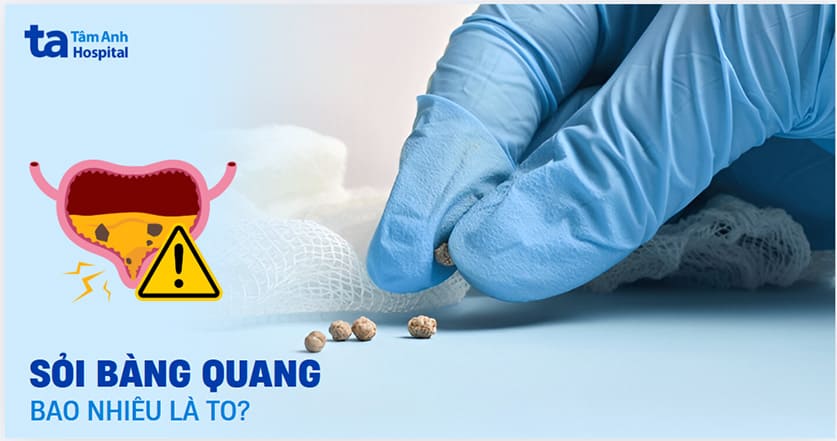 Sỏi bàng quang bao nhiêu là to? Bao nhiêu sẽ gây nguy hiểm?