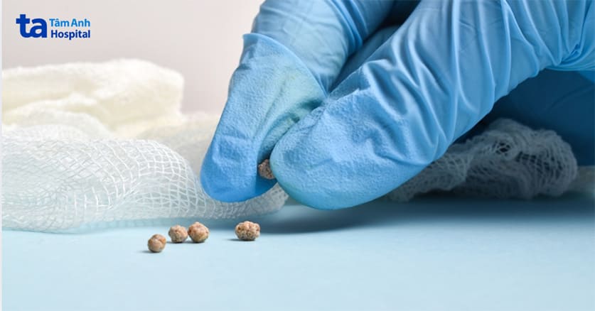 sỏi bàng quang cần điều trị sớm để ngăn ngừa biến chứng