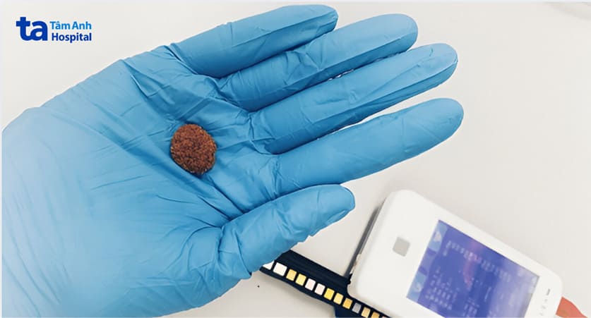 sỏi to có kích thước hơn 10mm