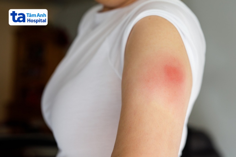 sưng đỏ chỗ tiêm sau khi chích ngừa hpv
