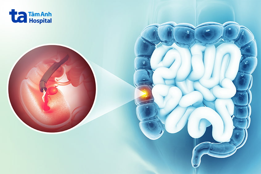 tầm soát ung thư đại tràng bằng nội soi
