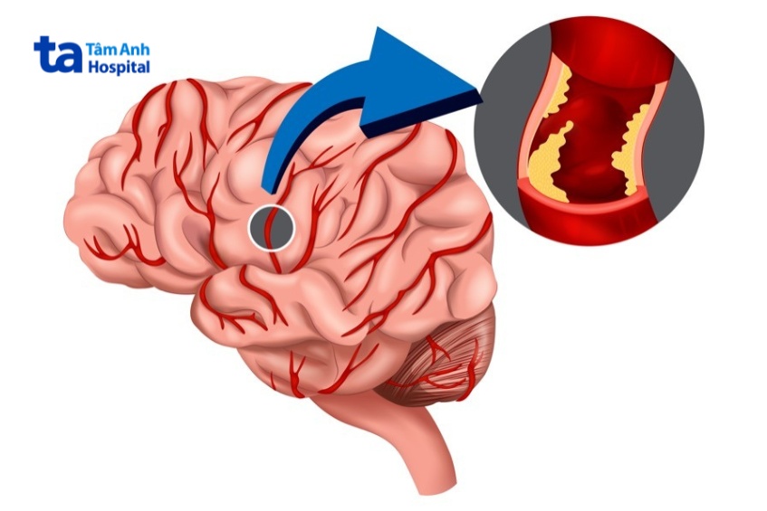 thiếu máu não gây tê bì ở chân