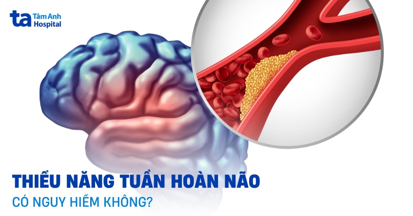 Bệnh thiểu năng tuần hoàn não có nguy hiểm không? Ảnh hưởng ra sao?
