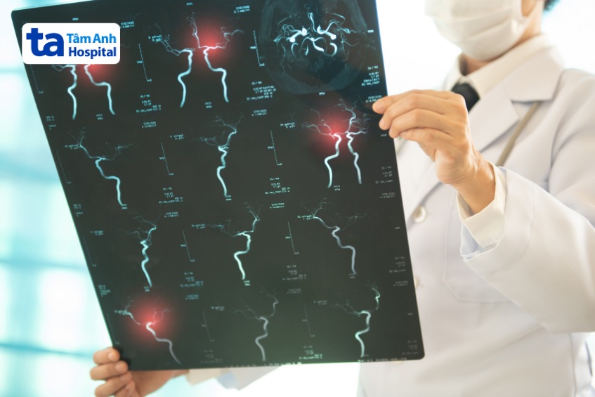 thiểu năng tuần hoàn não có thể chữa khỏi