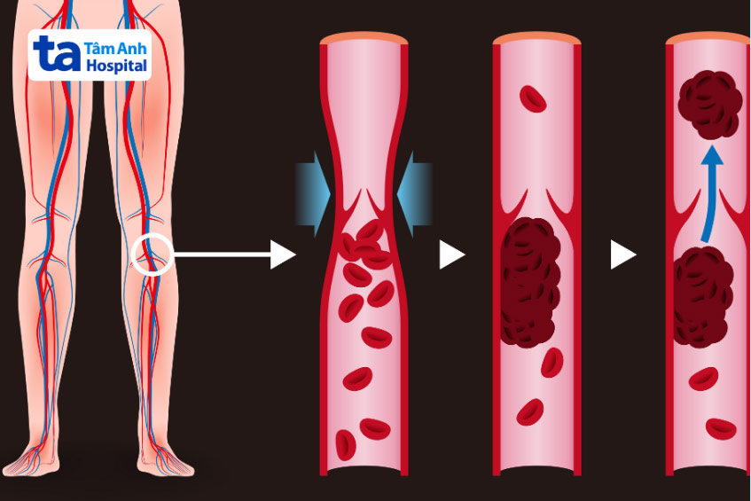 Thuốc chống đông kháng vitamin K được sử dụng trong điều trị và phòng ngừa thứ phát huyết khối tĩnh mạch