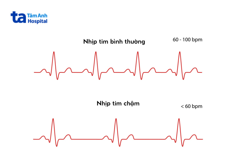 Thuốc điều trị rối loạn nhịp tim được chỉ định ở bệnh nhân có nhịp tim chậm dưới 60 nhịp/phút
