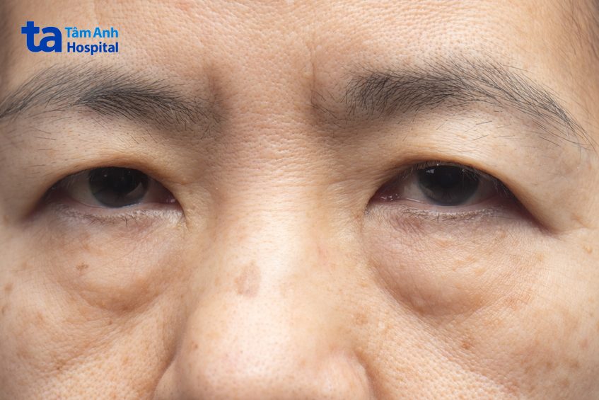 thuốc và phẫu thuật là phương pháp trị sụp mí