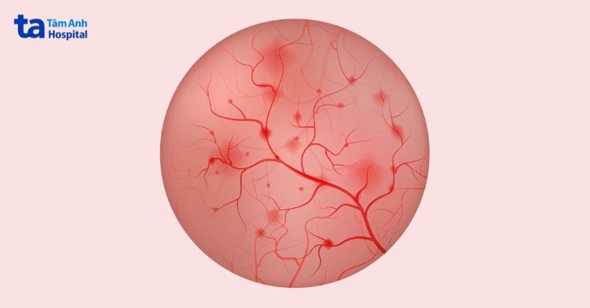 tia bức xạ làm tổn thương các mạch máu ở niêm mạc bàng quang