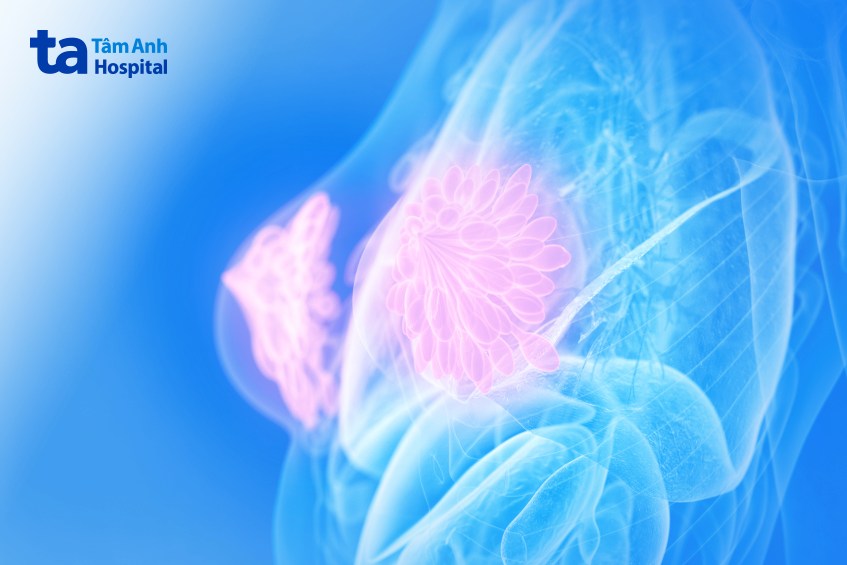 tiên lượng ung thư vú luminal A tùy thuộc vào kích thước khối u