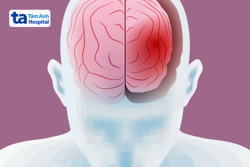 tìm hiểu teo não ở người cao tuổi có nguy hiểm không