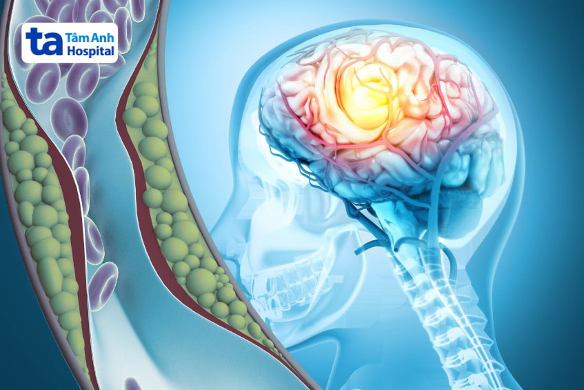 tìm hiểu thiểu năng tuần hoàn não và cách điều trị