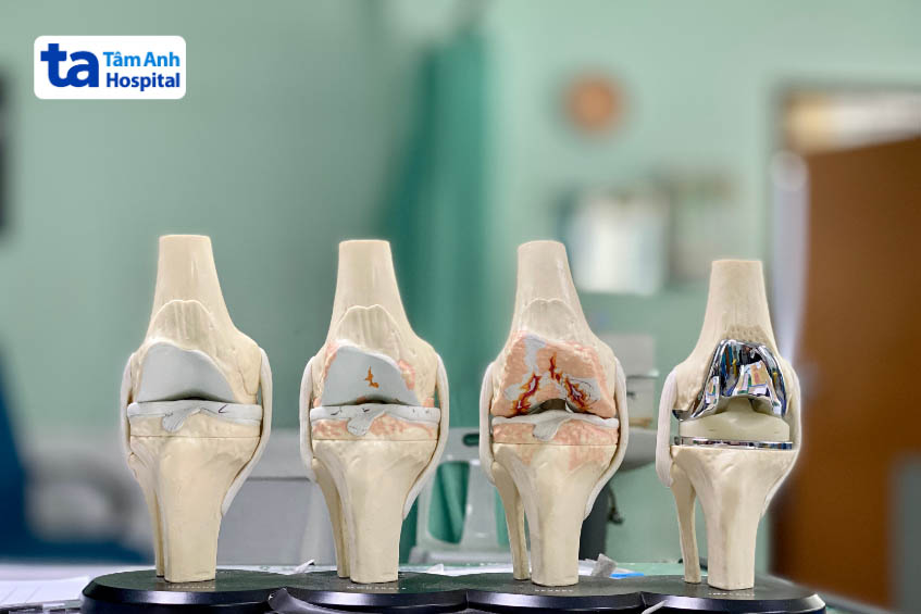 triệu chứng của biến chứng thoái hóa khớp