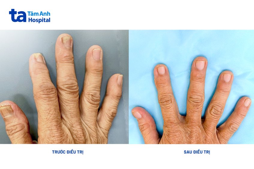 trước và sau khi điều trị