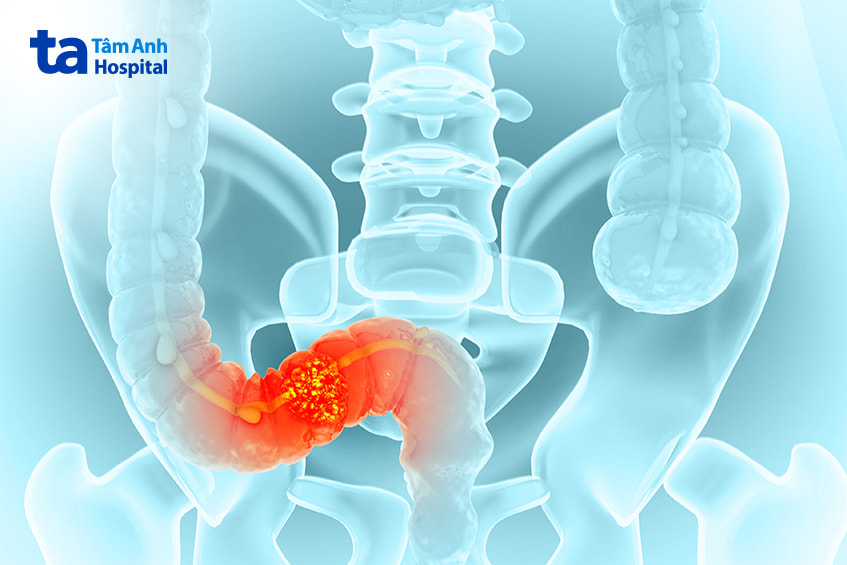 ung thư đại tràng không thể lây từ người sang người