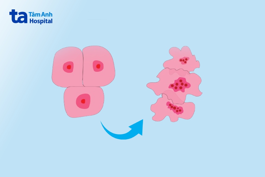 ung thư vú luminal a là gì