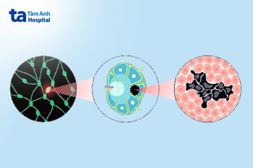 vi di căn là cụm tế bào ung thư