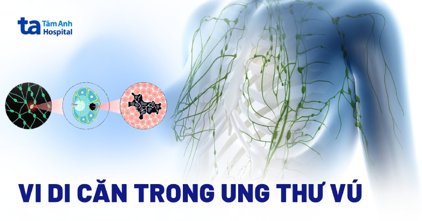 Vi di căn trong ung thư vú: Chẩn đoán, cách điều trị và tiên lượng