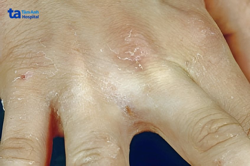 ví dụ triệu chứng ghẻ