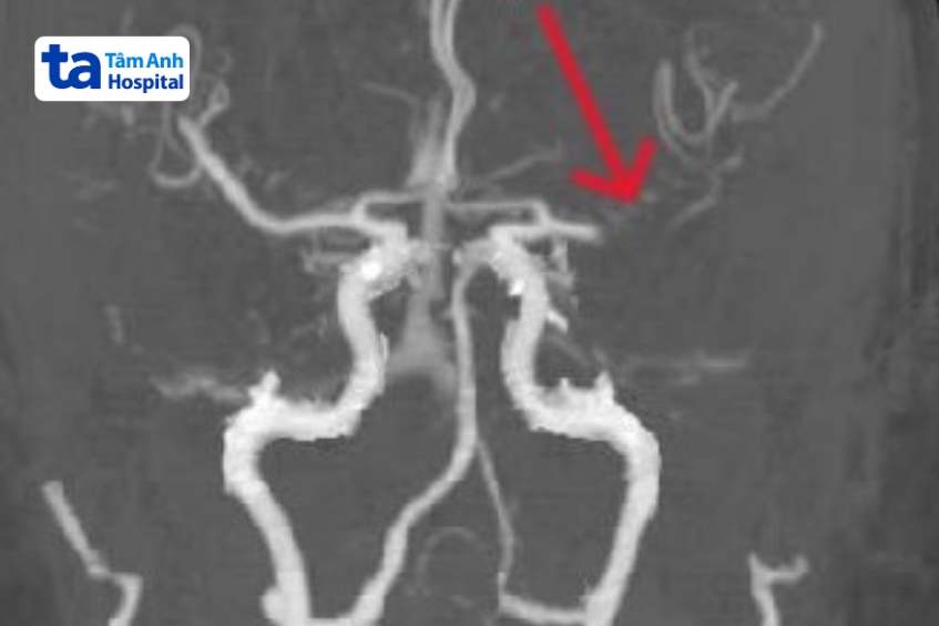 vị trí động mạch não giữa trái bị tắc hoàn toàn