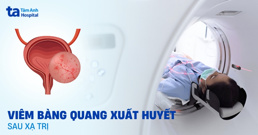 Viêm bàng quang xuất huyết sau xạ trị: Nguyên nhân và cách điều trị
