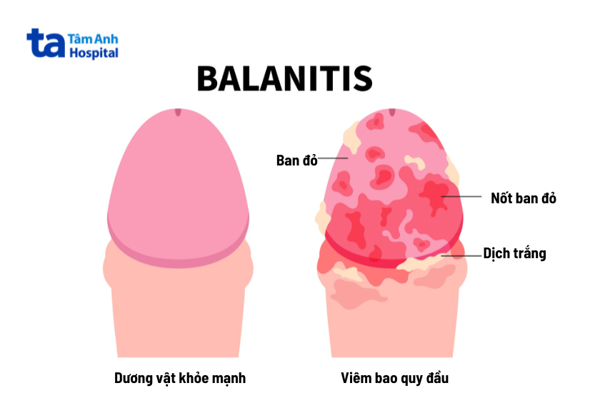 Viêm bao quy đầu nặng có thể xuất hiện tình trạng lở loét, mưng mủ