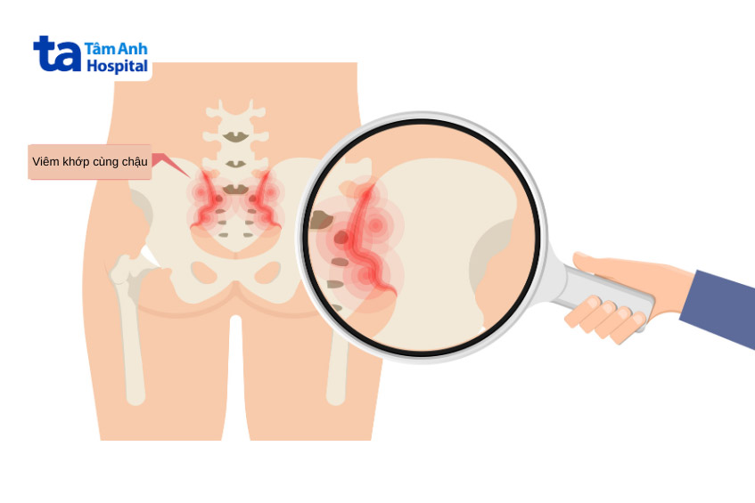 Viêm khớp cùng chậu gây nhiều ảnh hưởng tới người bệnh