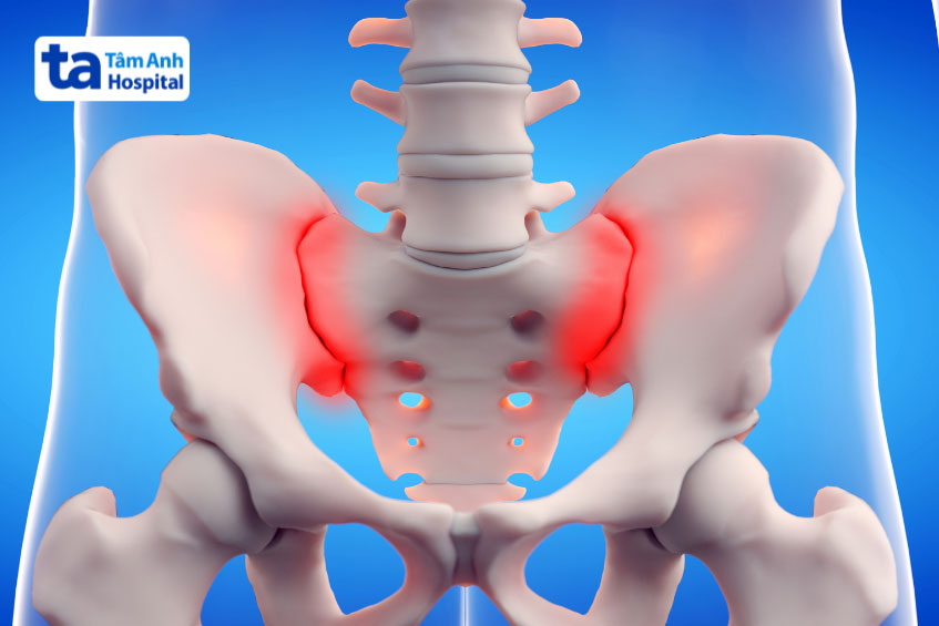 Viêm khớp cùng chậu là bệnh gì