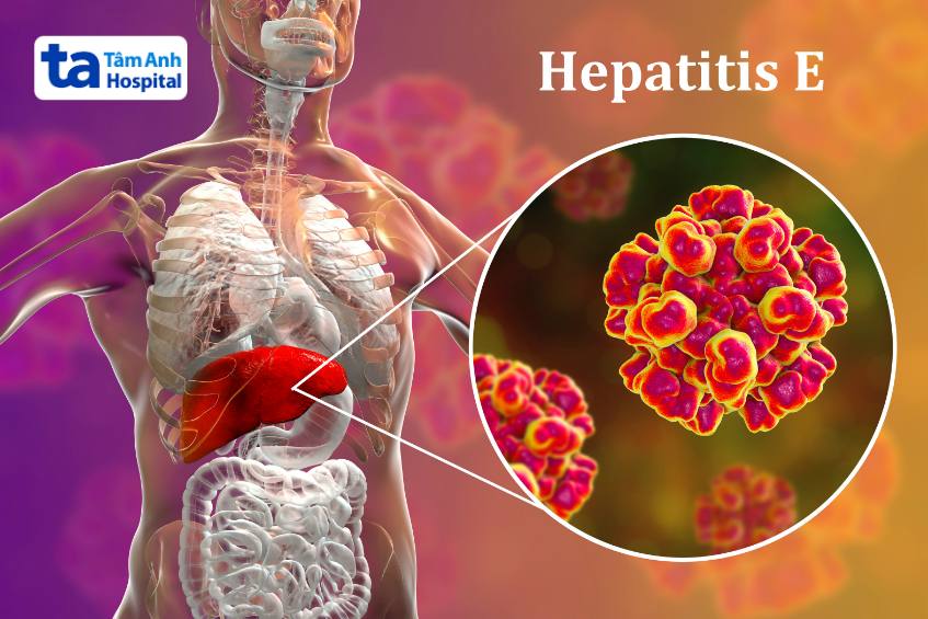virus viêm gan e