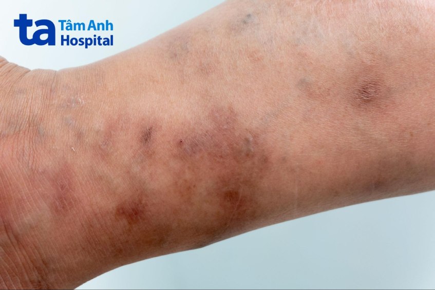 vùng da mà ký sinh trùng ghẻ đào hàng