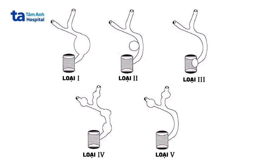 5 loại nang ống mật chủ